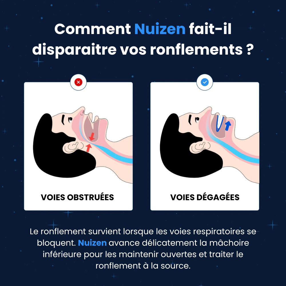 Gouttière anti-Ronflement sur Mesure - Nuizen